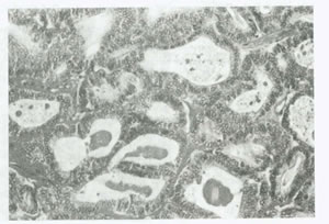 بيماريهاي تخمدان و لوله هاي رحمي چیست؟(1)